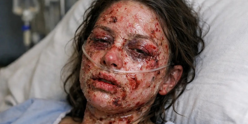 Imagem de mulher em leito com Síndrome de Stevens-Johnson.