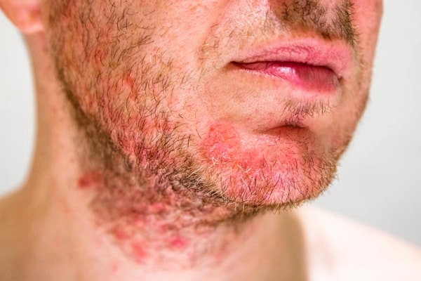 Homem com irritação, vermelhidão e pequenas lesões na região da barba, sinais que podem estar associados à foliculite.