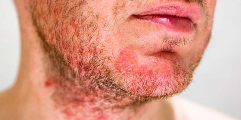 Homem com irritação, vermelhidão e pequenas lesões na região da barba, sinais que podem estar associados à foliculite.