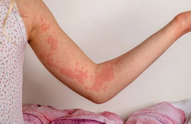 Braço com vermelhidão e manchas na pele, representando dermatite alérgica e reação cutânea inflamatória.