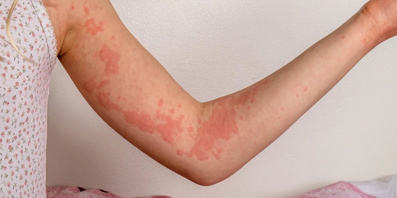 Braço com vermelhidão e manchas na pele, representando dermatite alérgica e reação cutânea inflamatória.