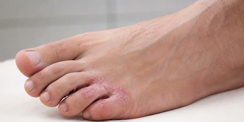 Close-up de um pé com descamação, vermelhidão e lesões entre os dedos com micose cutânea tratada com itraconazol.