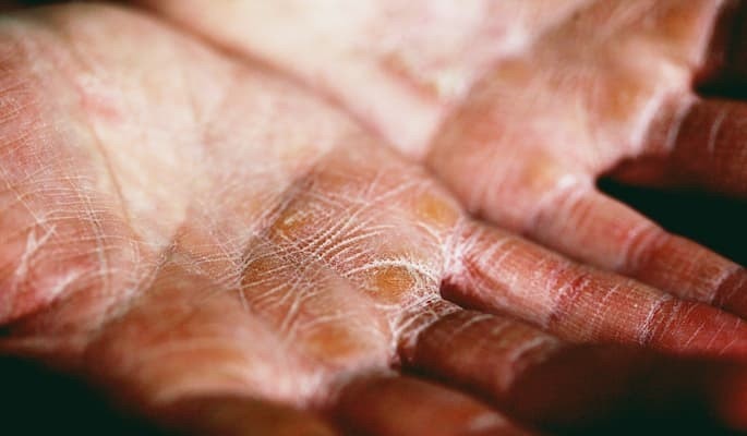 Close-up da palma da mão com múltiplas lesões circulares amareladas e áreas de descamação na pele com alterações cutâneas compatíveis com necrose epidérmica tóxica.
