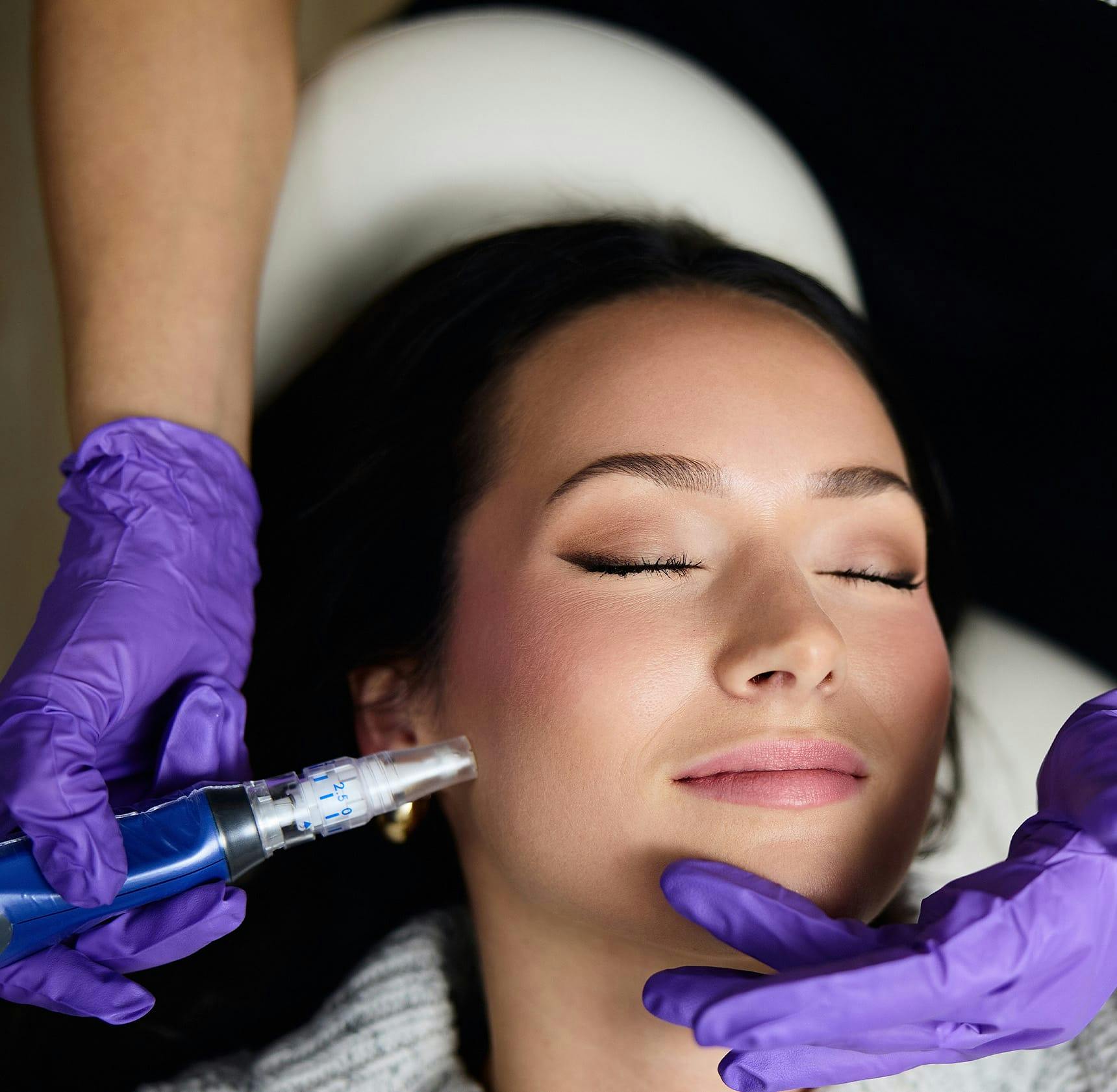 female patient getting microneedling procedure done on her fac