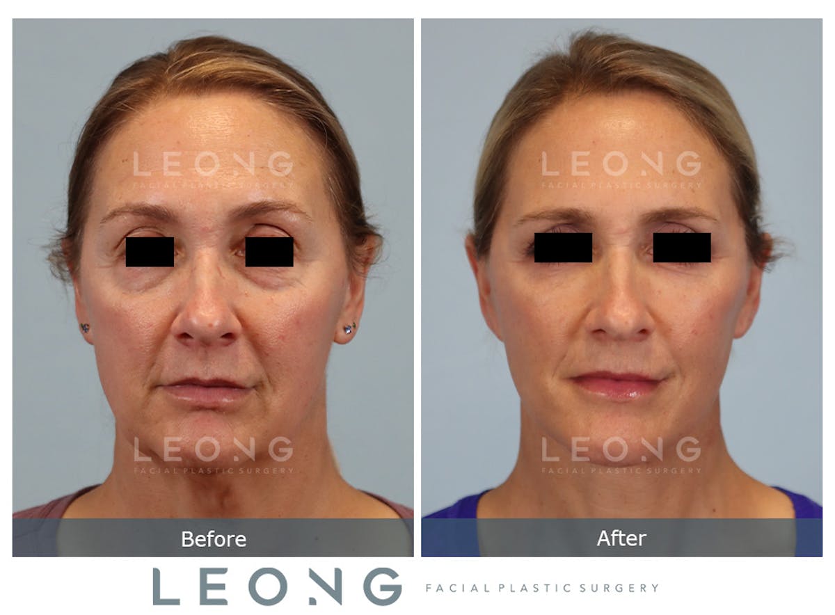Facelift Before & After Gallery - Patient 377022 - Image 1