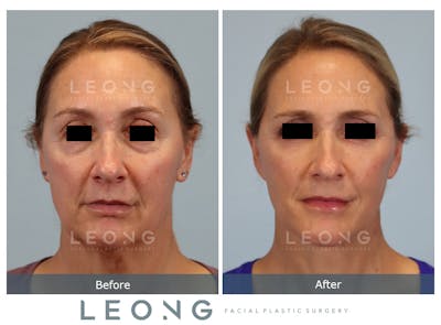 Facelift Before & After Gallery - Patient 377022 - Image 1