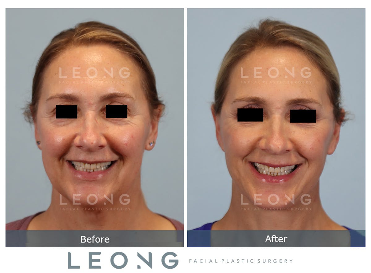 Facelift Before & After Gallery - Patient 377022 - Image 2