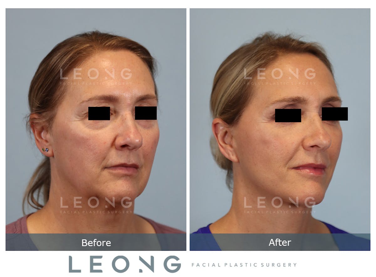 Facelift Before & After Gallery - Patient 377022 - Image 3