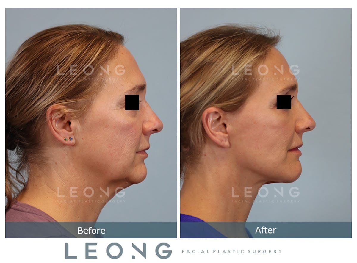 Facelift Before & After Gallery - Patient 377022 - Image 4