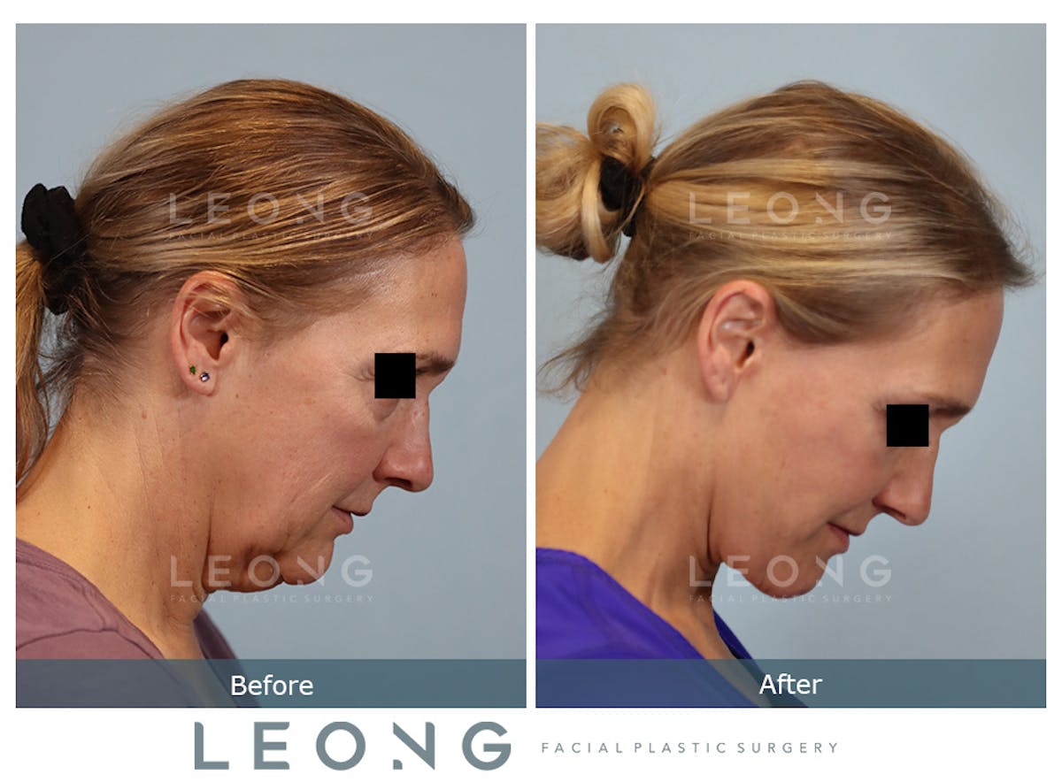 Facelift Before & After Gallery - Patient 377022 - Image 5