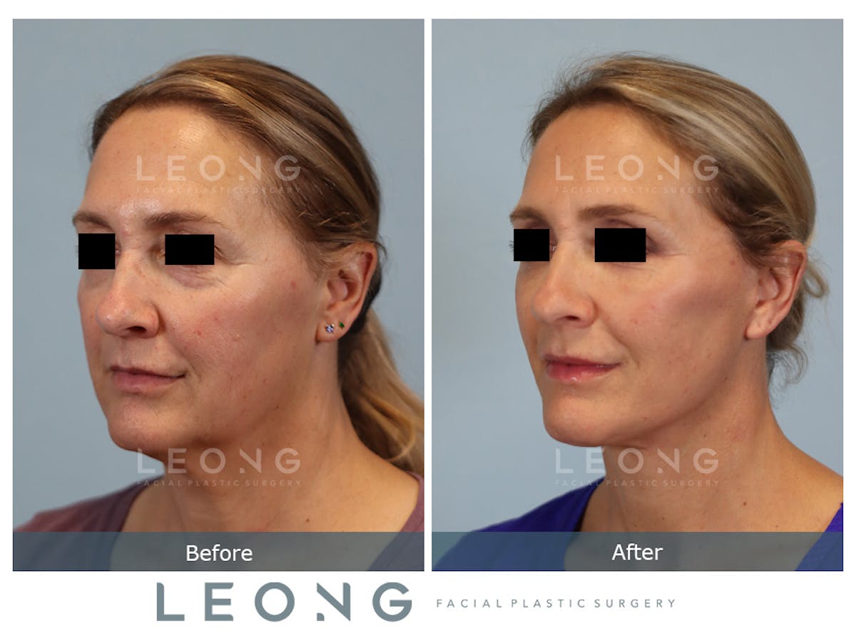 Facelift Before & After Gallery - Patient 377022 - Image 6