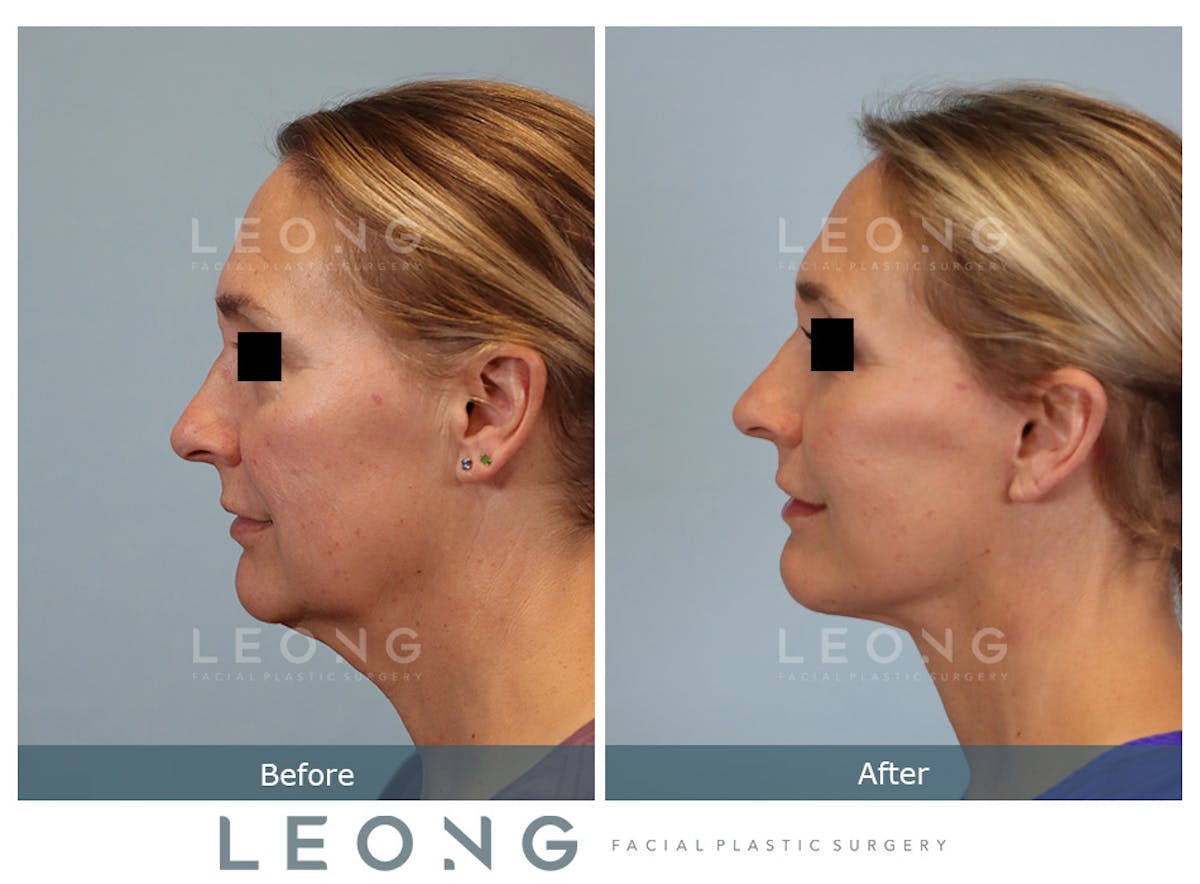 Facelift Before & After Gallery - Patient 377022 - Image 7