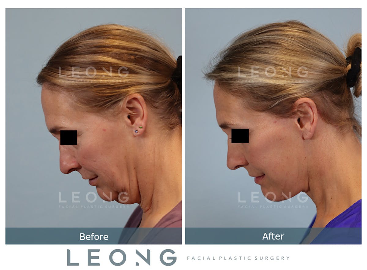 Facelift Before & After Gallery - Patient 377022 - Image 8