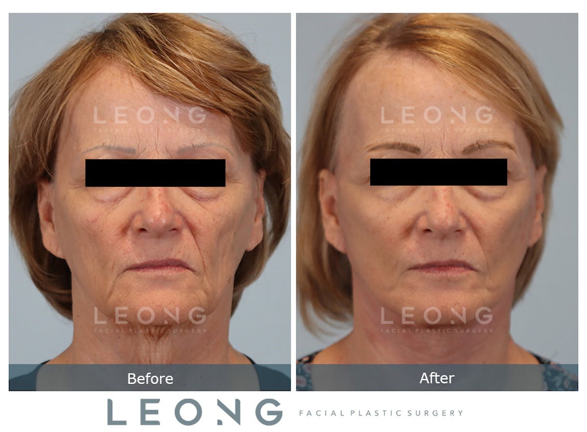 Facelift Before & After Gallery - Patient 378863 - Image 1