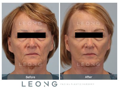 Facelift Before & After Gallery - Patient 378863 - Image 1