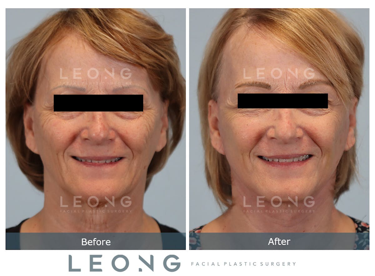 Facelift Before & After Gallery - Patient 378863 - Image 2