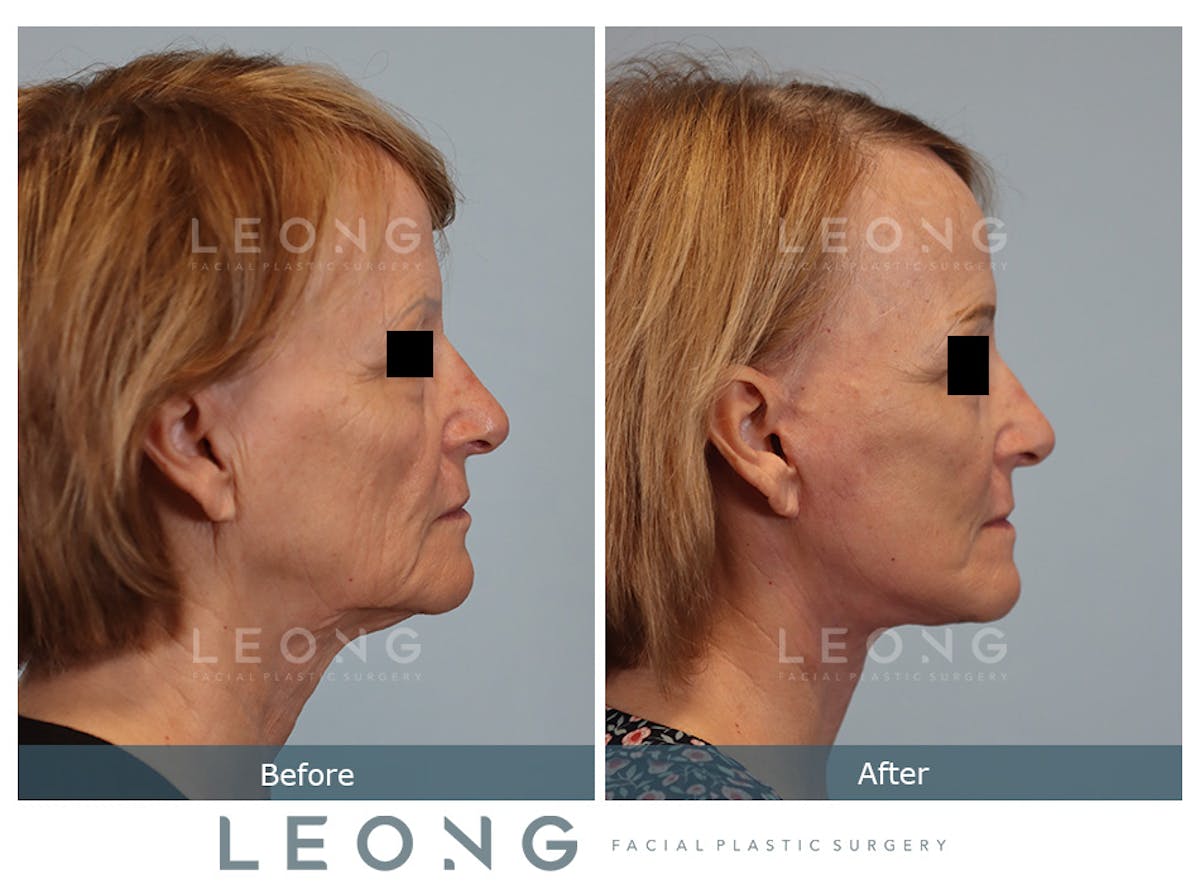 Facelift Before & After Gallery - Patient 378863 - Image 4