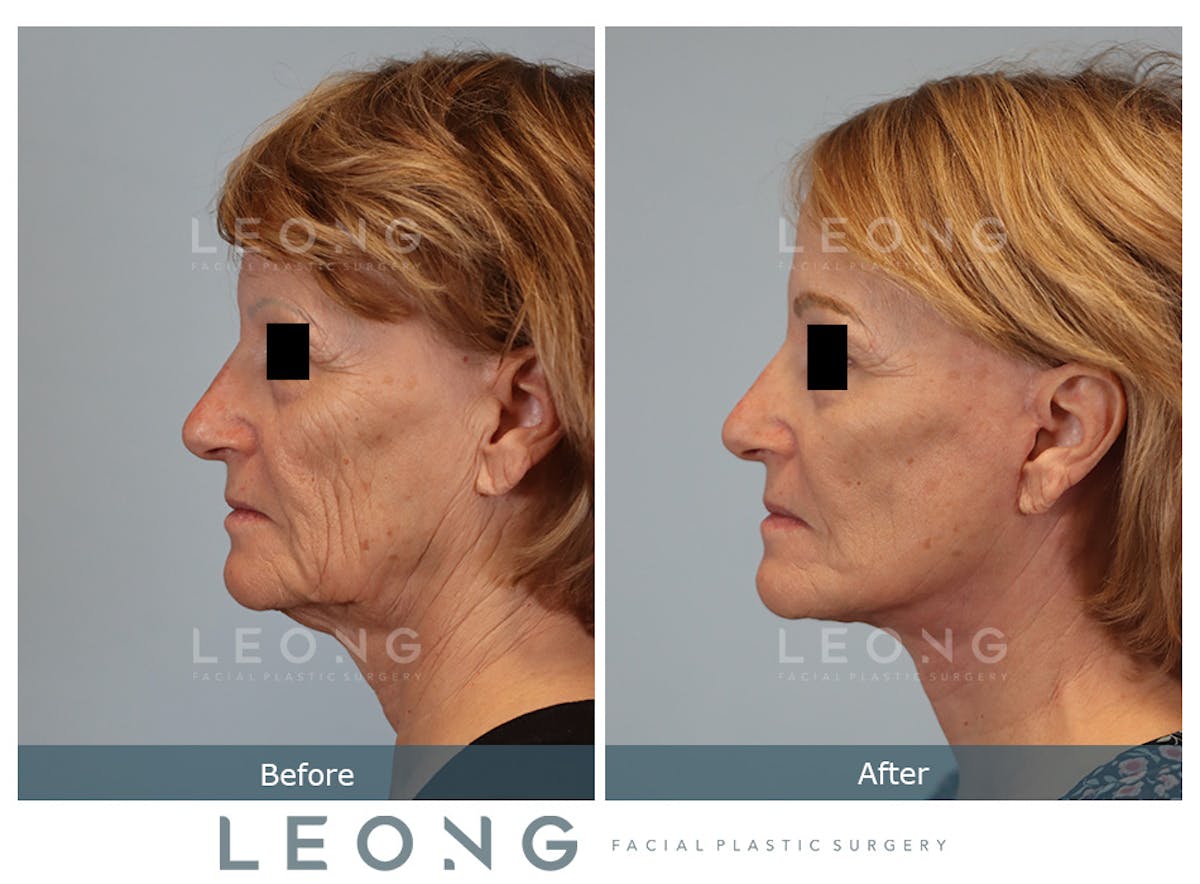 Facelift Before & After Gallery - Patient 378863 - Image 5