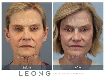 Facelift Before & After Gallery - Patient 376596 - Image 1