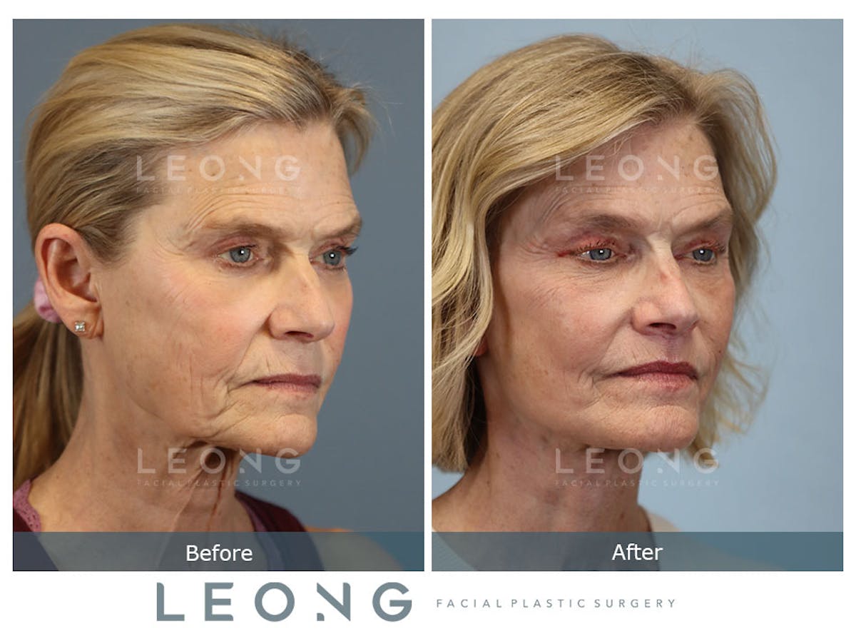 Facelift Before & After Gallery - Patient 376596 - Image 2