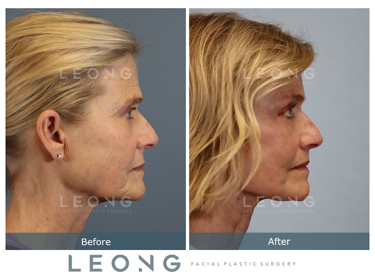 Facelift Before & After Gallery - Patient 376596 - Image 3