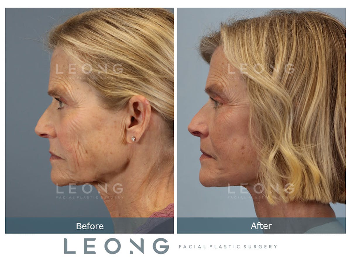 Facelift Before & After Gallery - Patient 376596 - Image 4