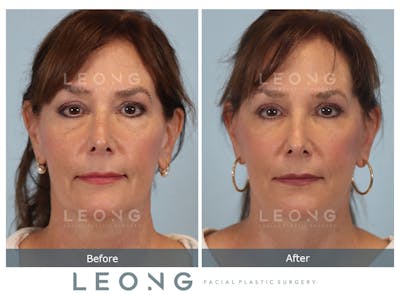 Facelift Before & After Gallery - Patient 767837 - Image 1