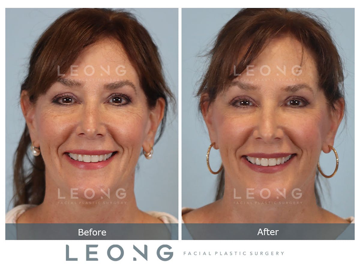 Facelift Before & After Gallery - Patient 767837 - Image 2