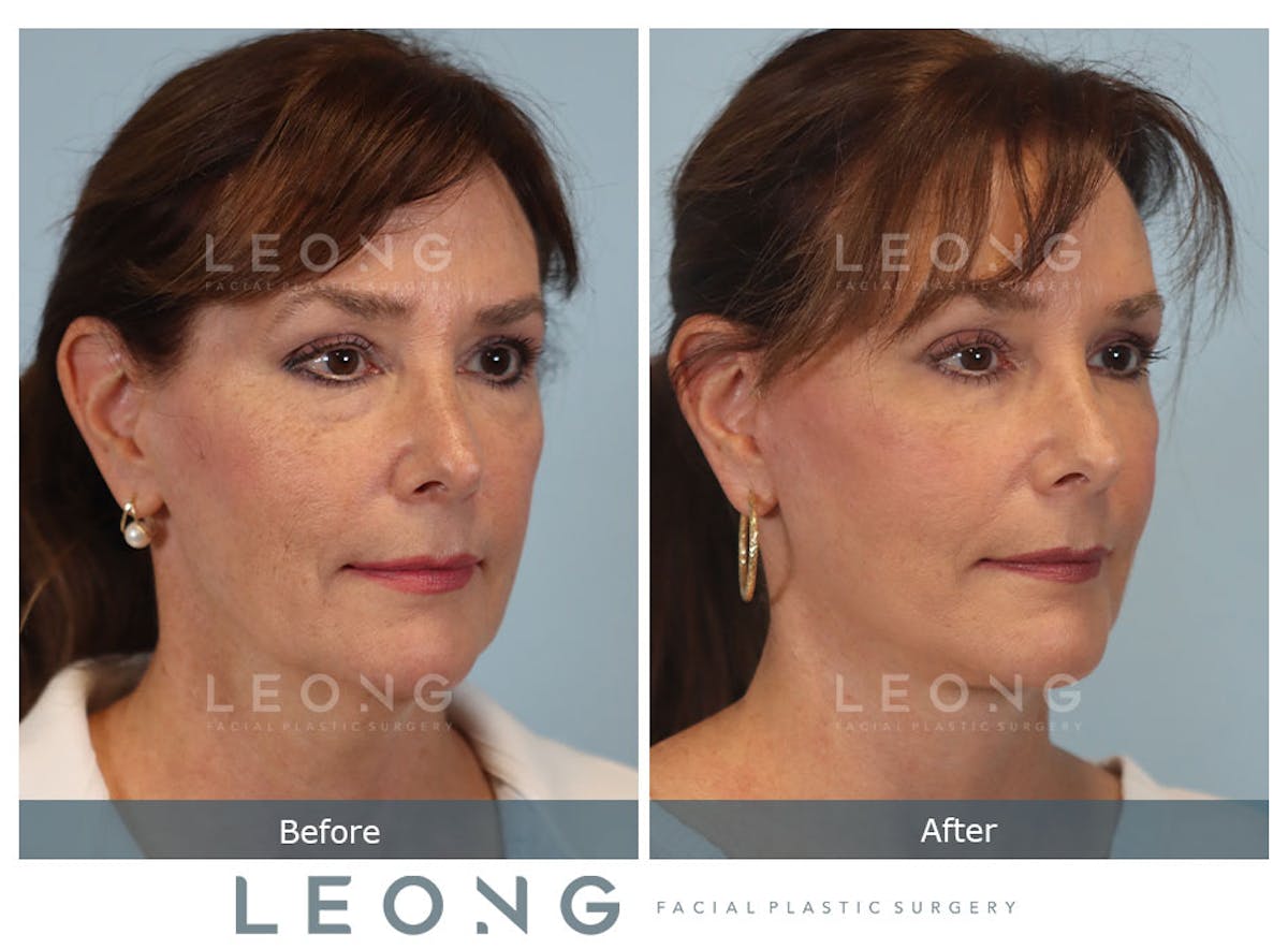 Facelift Before & After Gallery - Patient 767837 - Image 3