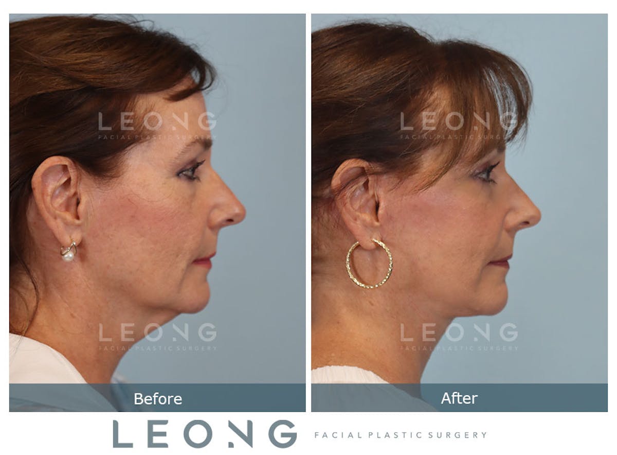 Facelift Before & After Gallery - Patient 767837 - Image 4
