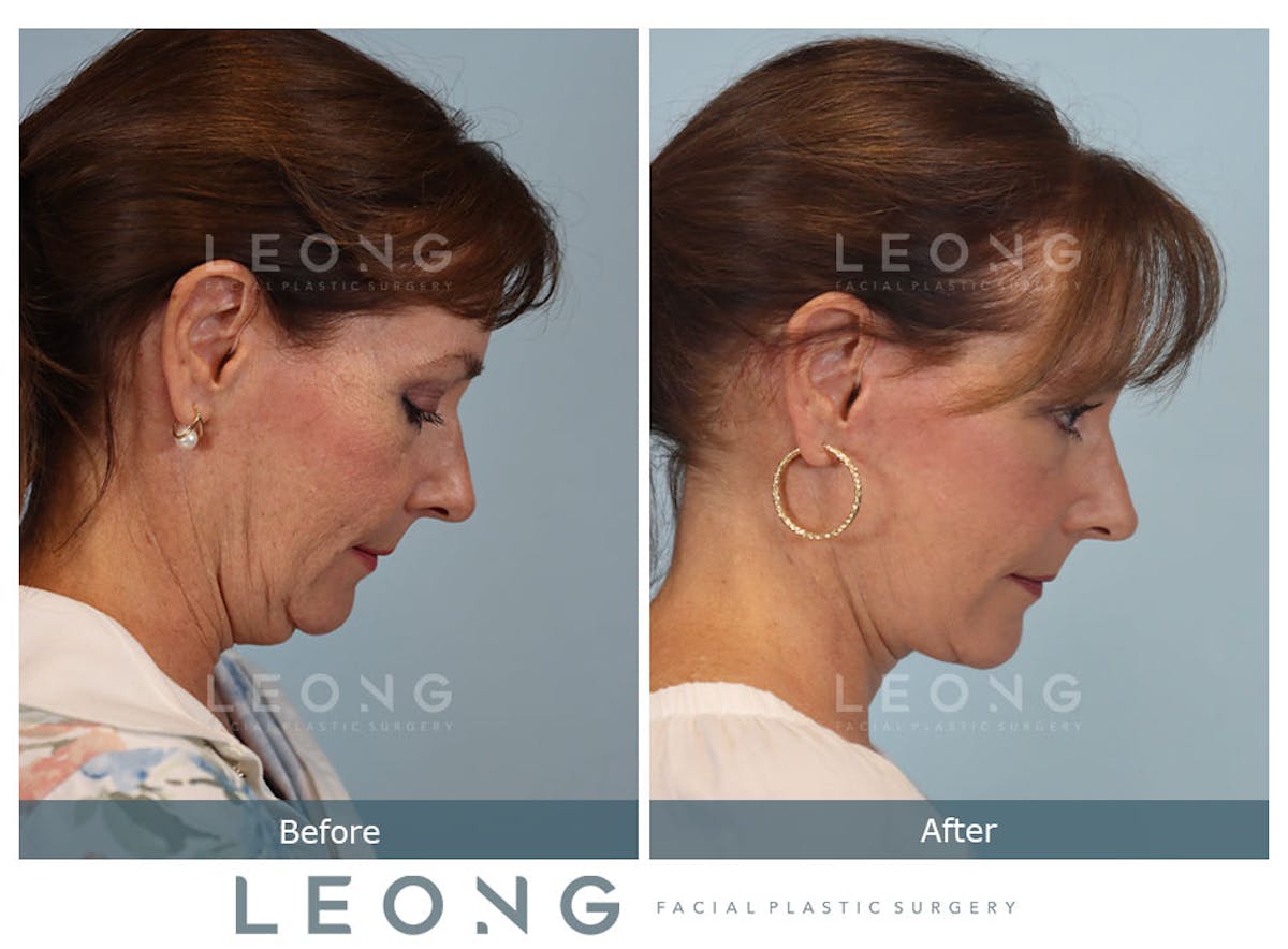 Facelift Before & After Gallery - Patient 767837 - Image 5