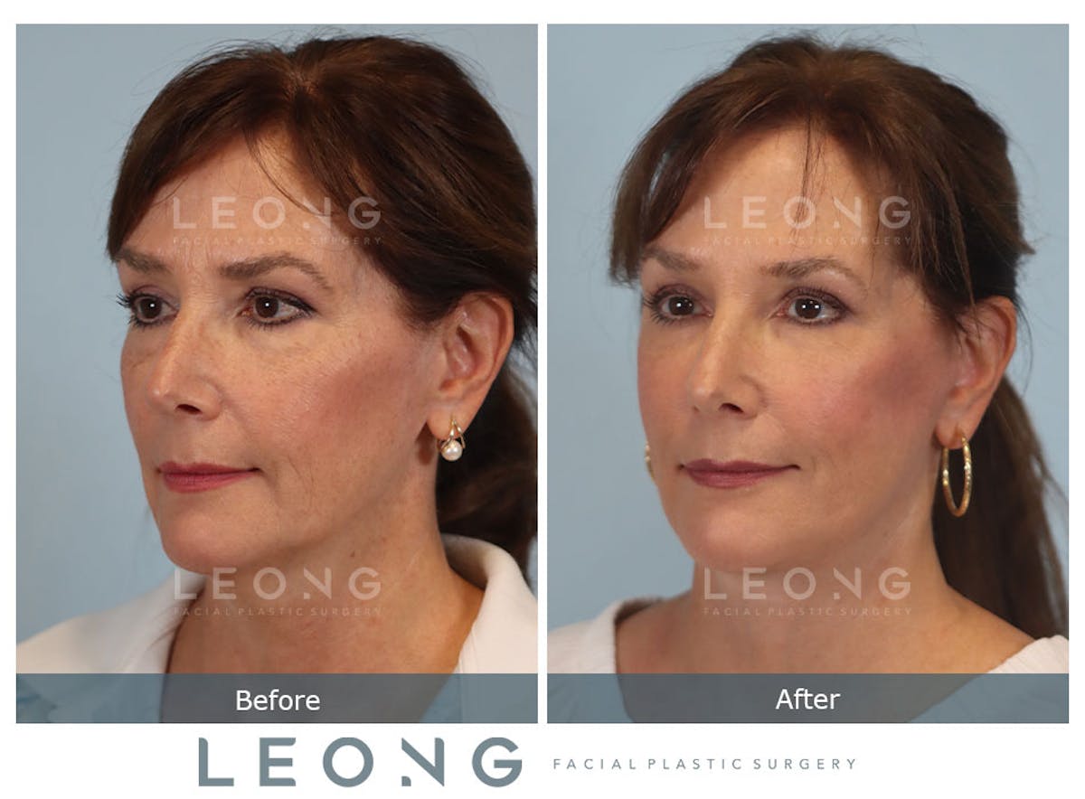 Facelift Before & After Gallery - Patient 767837 - Image 6