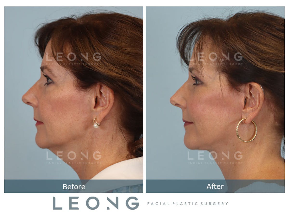 Facelift Before & After Gallery - Patient 767837 - Image 7