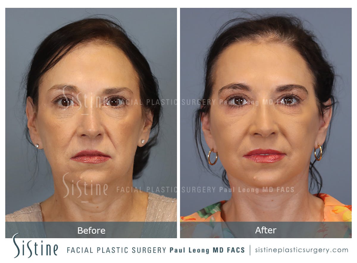 Facelift Before & After Gallery - Patient 235559 - Image 1