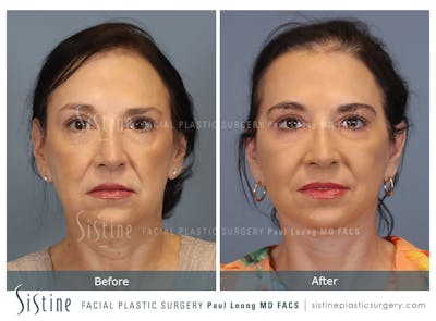 Facelift Before & After Gallery - Patient 235559 - Image 1
