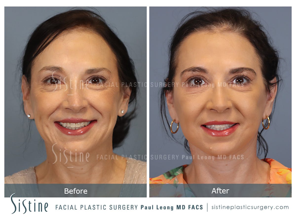 Facelift Before & After Gallery - Patient 235559 - Image 2