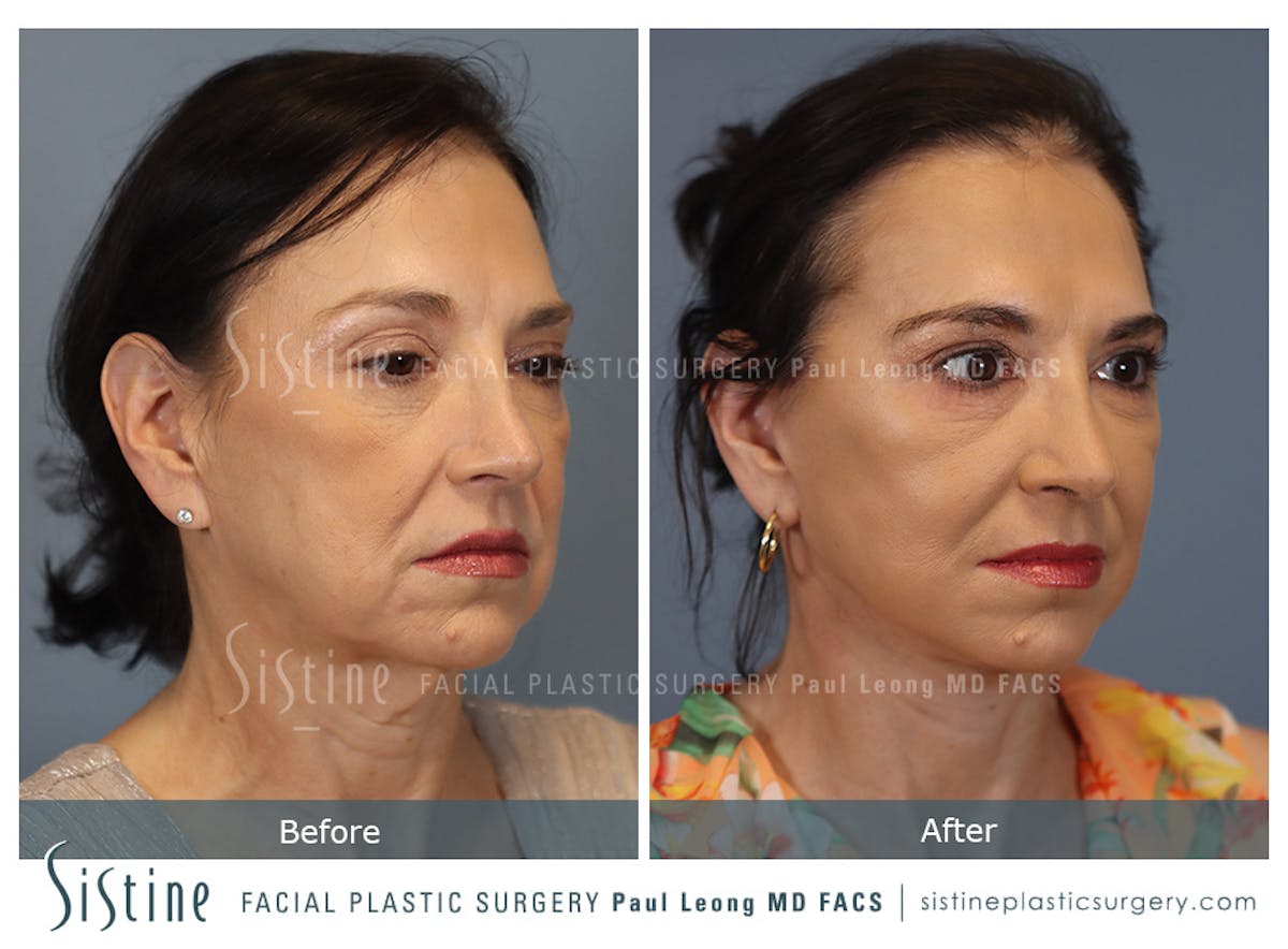 Facelift Before & After Gallery - Patient 235559 - Image 3