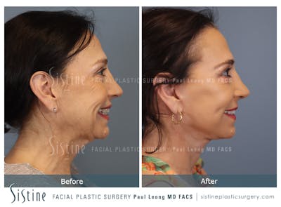 Deep Neck Lift Before & After Gallery - Patient 333506 - Image 1