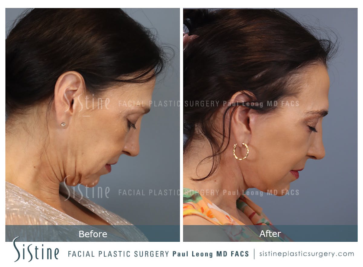 Facelift Before & After Gallery - Patient 235559 - Image 5