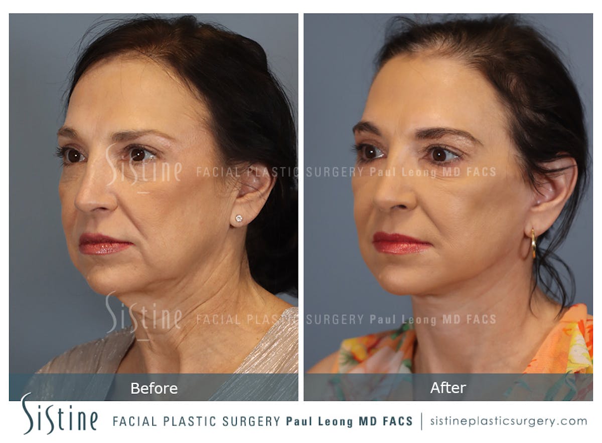 Facelift Before & After Gallery - Patient 235559 - Image 6