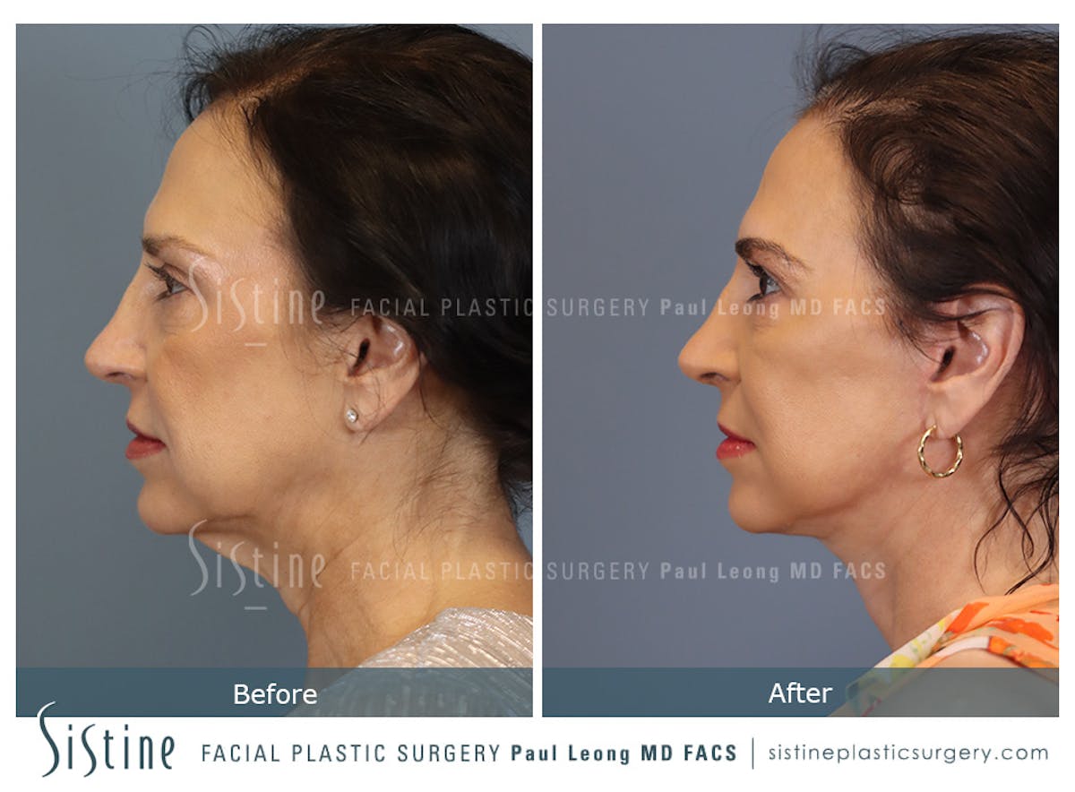 Facelift Before & After Gallery - Patient 235559 - Image 7