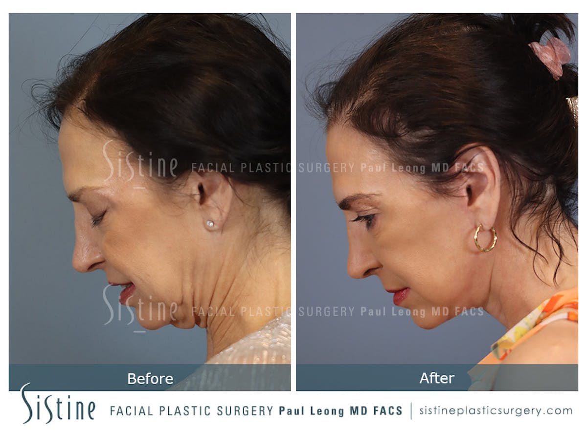 Facelift Before & After Gallery - Patient 235559 - Image 8