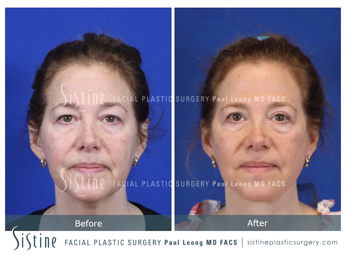 Blepharoplasty Before & After Gallery - Patient 214423 - Image 1