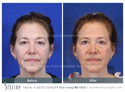 Facelift Before & After Gallery - Patient 495050 - Image 1