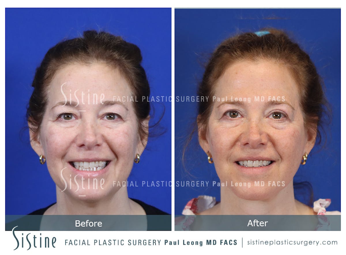 Blepharoplasty Before & After Gallery - Patient 214423 - Image 2