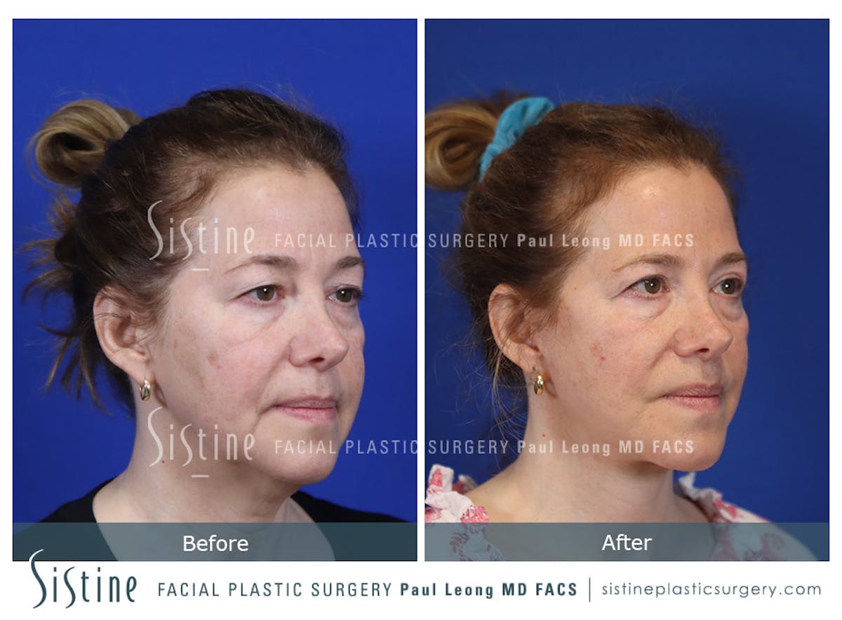 Blepharoplasty Before & After Gallery - Patient 214423 - Image 3