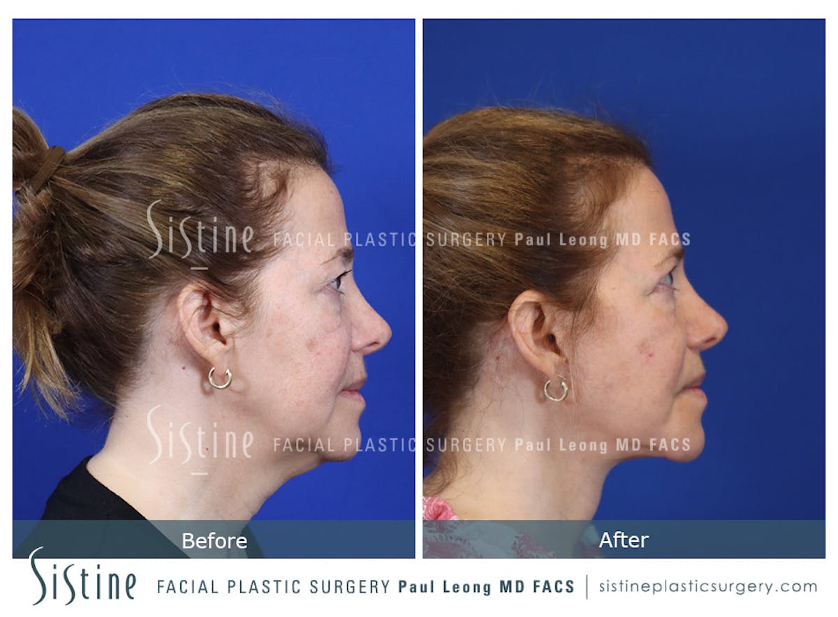Blepharoplasty Before & After Gallery - Patient 214423 - Image 4
