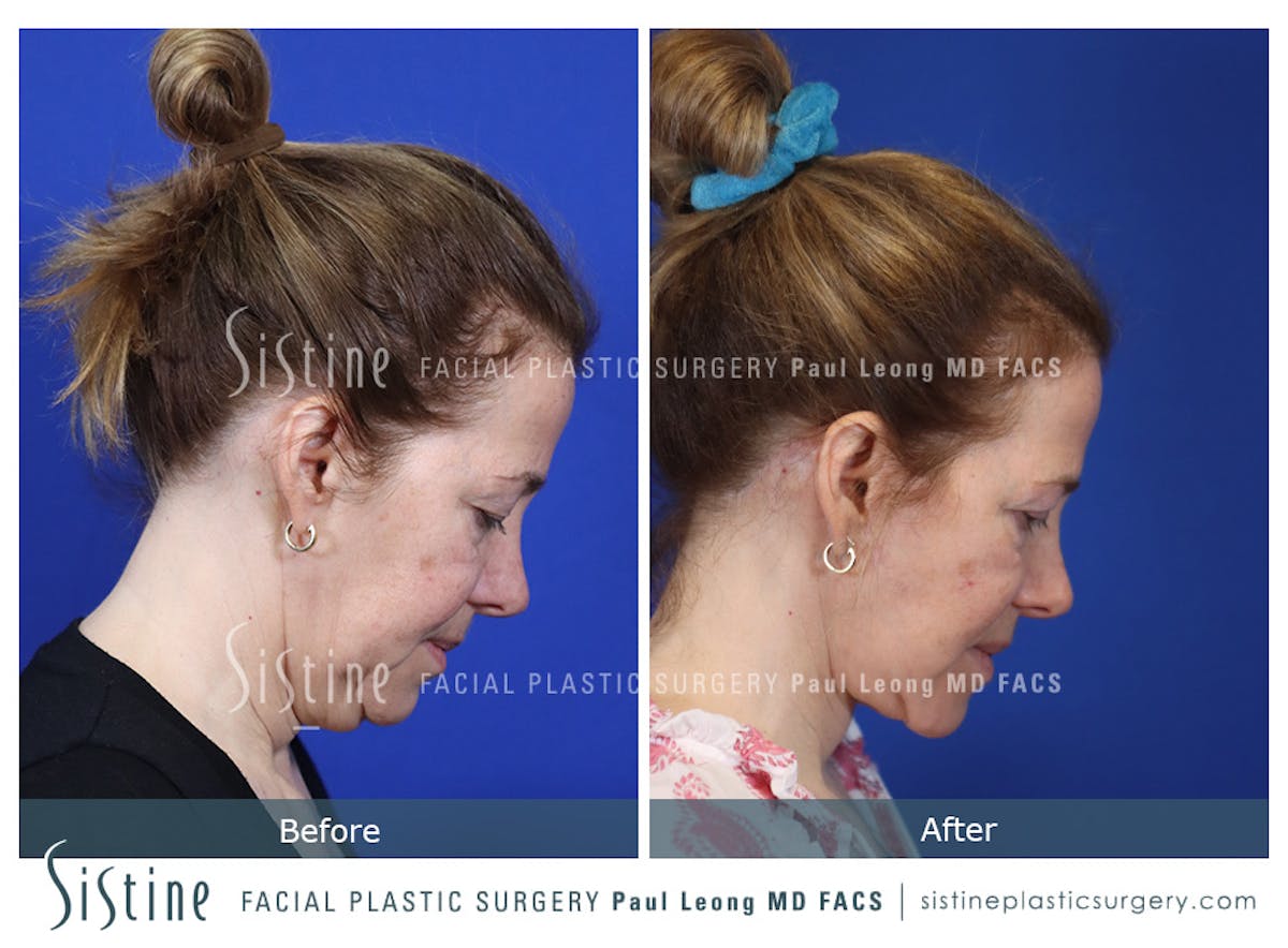 Blepharoplasty Before & After Gallery - Patient 214423 - Image 5