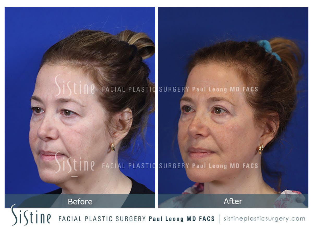 Blepharoplasty Before & After Gallery - Patient 214423 - Image 6