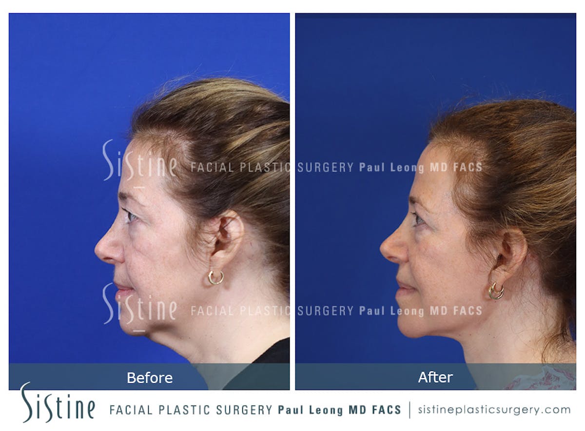 Blepharoplasty Before & After Gallery - Patient 214423 - Image 7